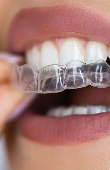 Invisalign
