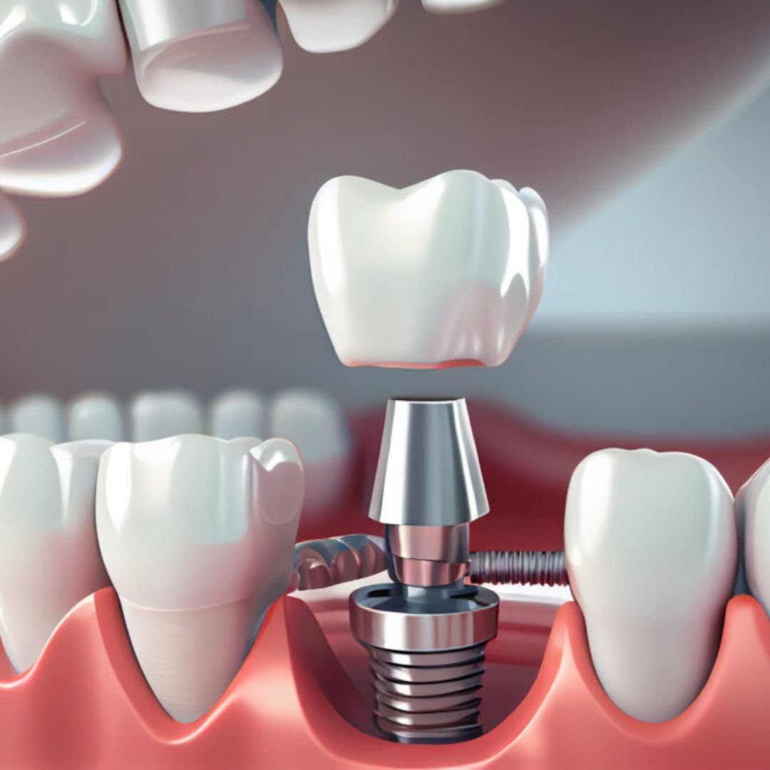 Próteses e implantes